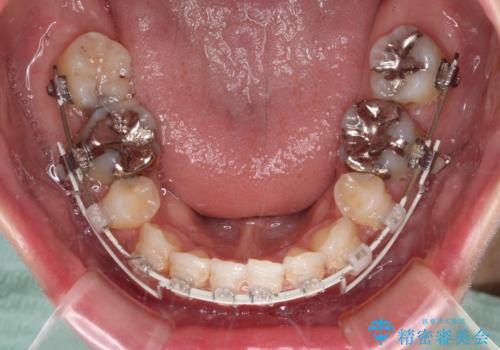 顎先に梅干し皺ができる　閉じにくい唇を抜歯矯正で閉じやすくの治療中