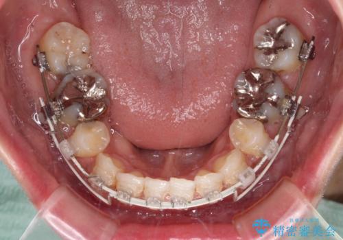 顎先に梅干し皺ができる 閉じにくい唇を抜歯矯正で閉じやすくの治療中