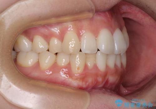 急速拡大装置 狭い歯列を拡大してワイヤー装置で短期間治療の治療前