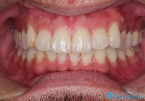 【インビザライン】前歯の凸凹を解消。の症例 治療前