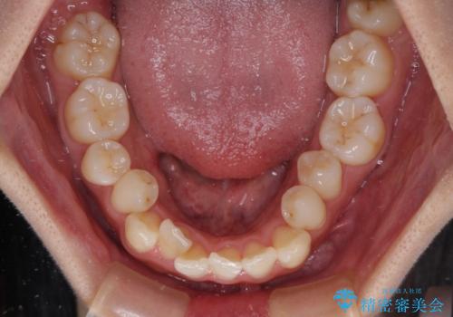 急速拡大装置 狭い歯列を拡大してワイヤー装置で短期間治療の治療前