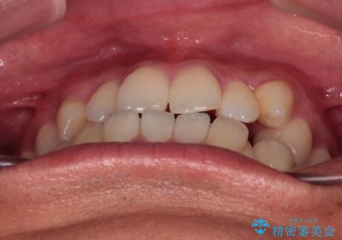 急速拡大装置 歯列弓を拡大して非抜歯ワイヤー矯正の治療前