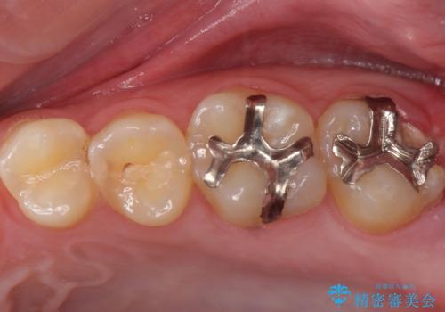 奥の虫歯 ジルコニアクラウンでの修復の症例 治療前