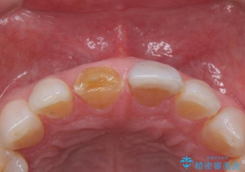 ラミネートべニアが取れた ジルコニアクラウンでの修復の治療前