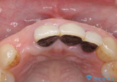 入れ歯を変えたい ブリッジでの修復治療の治療前