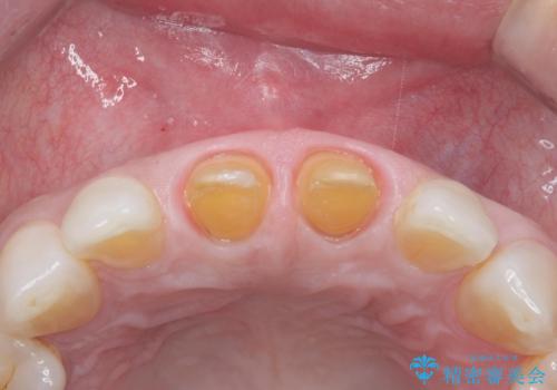 ラミネートべニアが取れた ジルコニアクラウンでの修復の治療中