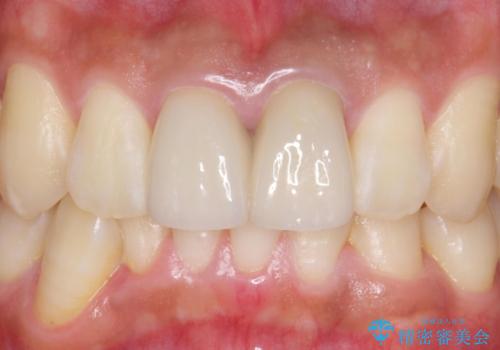 前歯を綺麗にしたい e-maxクラウンでの修復の治療後