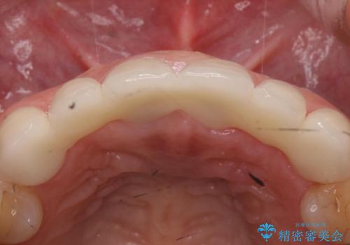 入れ歯を変えたい　ブリッジでの修復治療の治療後