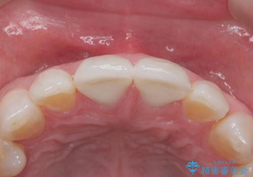 ラミネートべニアが取れた ジルコニアクラウンでの修復の治療後