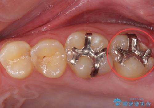 奥の虫歯　ジルコニアクラウンでの修復