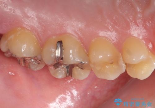 奥の虫歯 ジルコニアクラウンでの修復の治療前