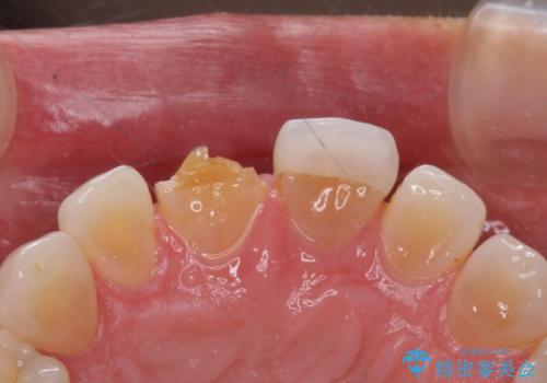 ラミネートべニアが取れた ジルコニアクラウンでの修復の治療前