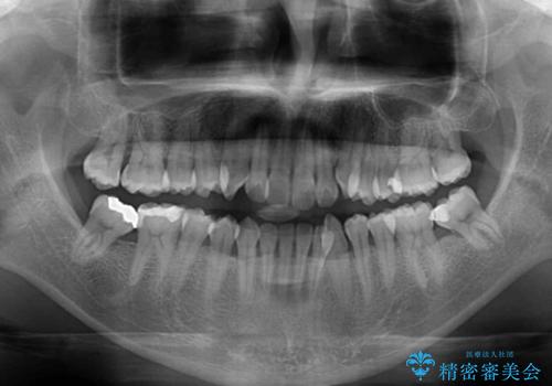 急速拡大装置　歯列弓を拡大して非抜歯ワイヤー矯正の治療前