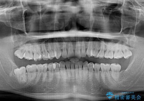 上下のデコボコを治したい　インビザラインによる矯正治療の治療前