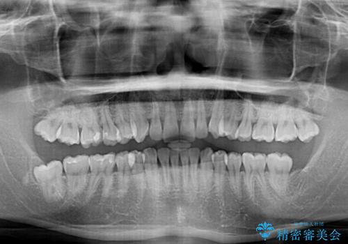 上下のデコボコを治したい インビザラインによる矯正治療の治療前