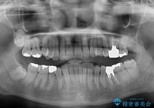 デコボコの歯とむし歯 インビザライン矯正治療とむし歯治療の治療前