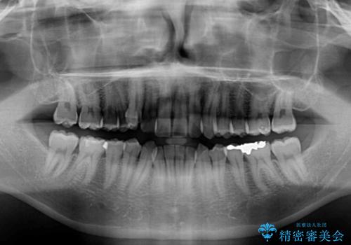 八重歯を無理なくなおしたい ワイヤー装置による非抜歯矯正治療の治療前