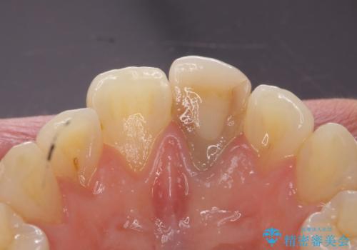 前歯が暗く変色 ジルコニアクラウンでの修復の治療前