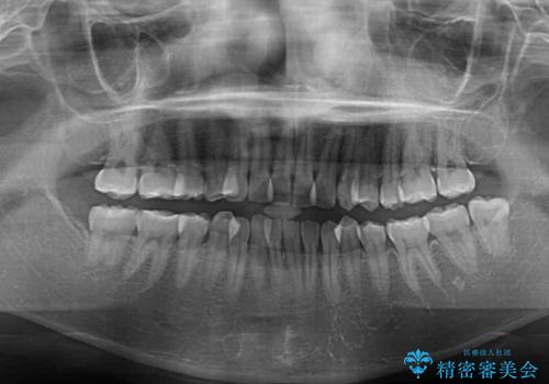 急速拡大装置 狭い歯列を拡大してワイヤー装置で短期間治療の治療前