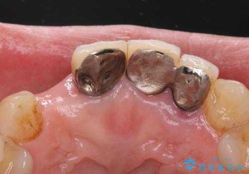 入れ歯を変えたい ブリッジでの修復治療の治療前