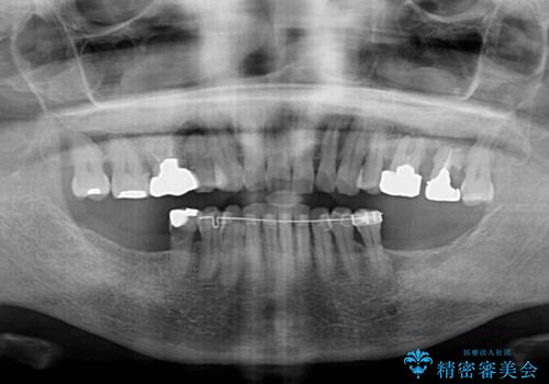 治療中で放置 インプラントでしっかりと咬めるようにの治療前
