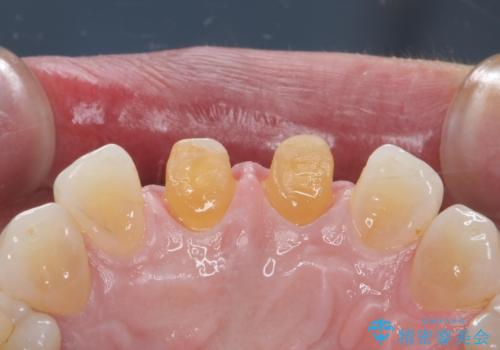 ラミネートべニアが取れた ジルコニアクラウンでの修復の治療中