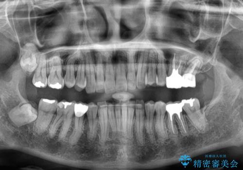 デコボコの歯とむし歯 インビザライン矯正治療とむし歯治療の治療後