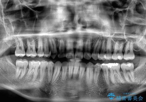 八重歯を無理なくなおしたい　ワイヤー装置による非抜歯矯正治療の治療後