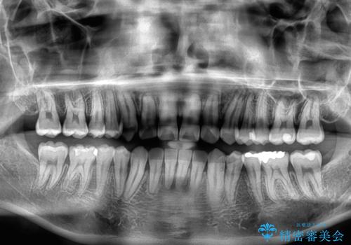 八重歯を無理なくなおしたい ワイヤー装置による非抜歯矯正治療の治療後