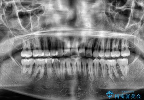 急速拡大装置 狭い歯列を拡大してワイヤー装置で短期間治療の治療後