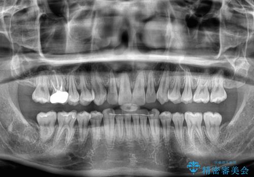 上下のデコボコを治したい インビザラインによる矯正治療の治療後