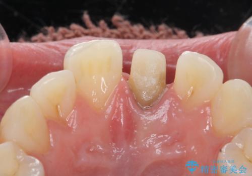 前歯が暗く変色 ジルコニアクラウンでの修復の治療中