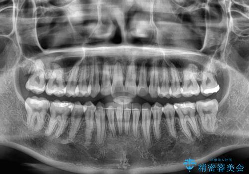 【モニター】インビザラインで気になるデコボコと八重歯をきれいに整えるの治療後