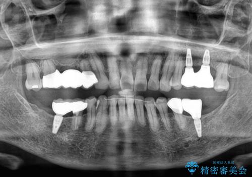 治療中で放置 インプラントでしっかりと咬めるようにの治療後