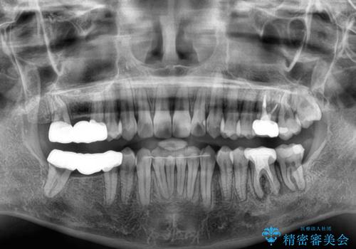 ワーキングホリデー前にきれいな歯列にの治療後