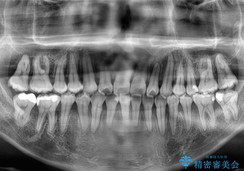急速拡大装置 歯列弓を拡大して非抜歯ワイヤー矯正の治療後