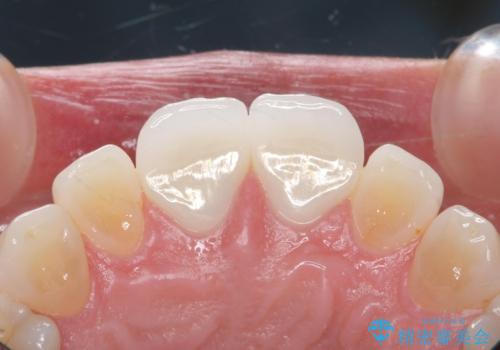 ラミネートべニアが取れた ジルコニアクラウンでの修復の治療後