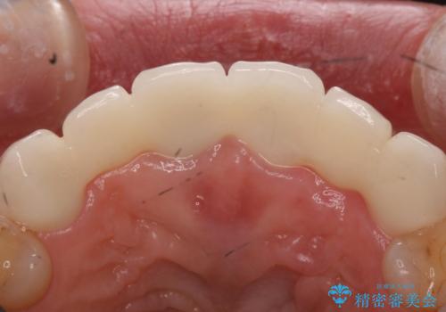 入れ歯を変えたい ブリッジでの修復治療の治療後