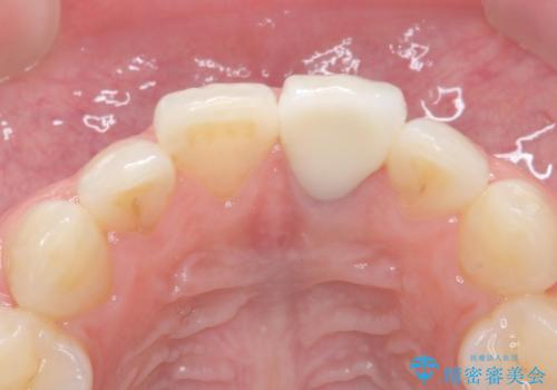 前歯が暗く変色 ジルコニアクラウンでの修復の治療後