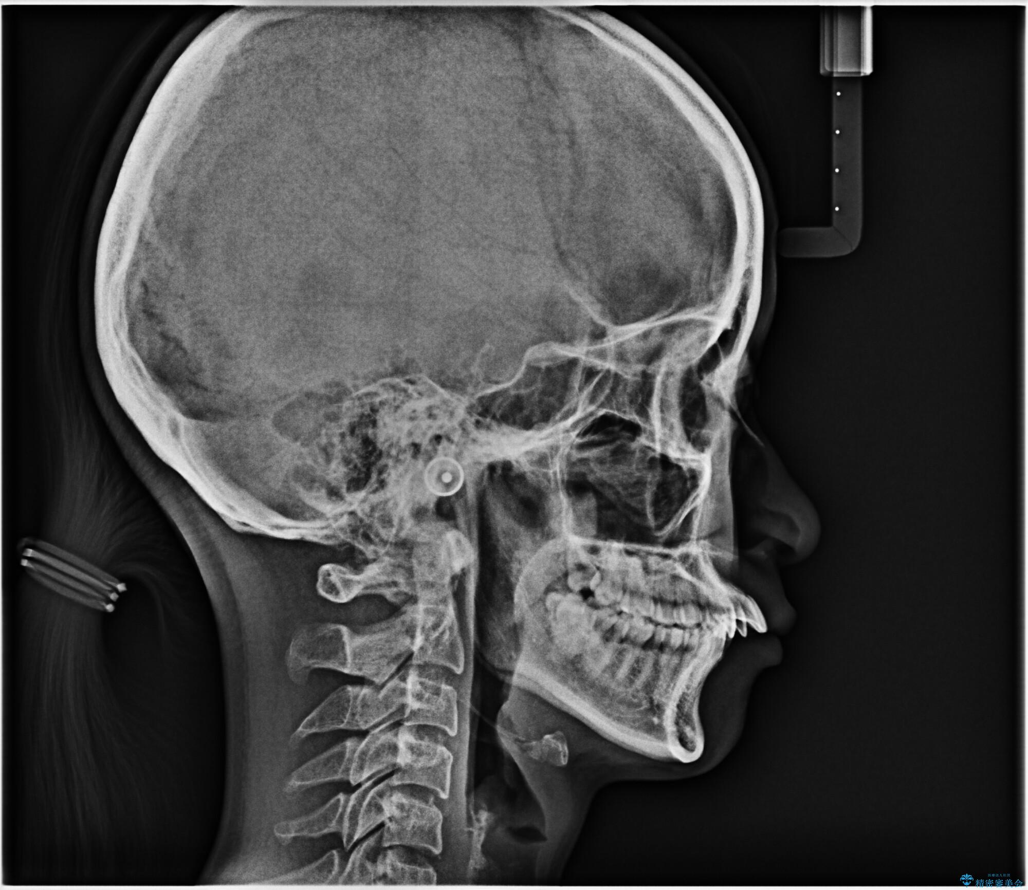 【インビザライン】前歯を下げたい。の治療前(顔貌)