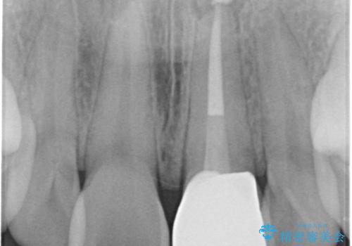 前歯が暗く変色 ジルコニアクラウンでの修復の治療後