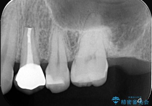 【外科的歯内療法】根管治療をしても違和感が残るの治療後