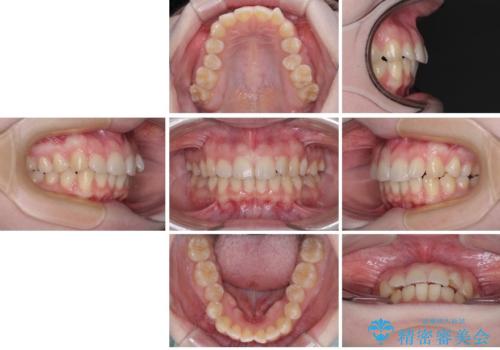 左上の前歯が出ているのが気になる　審美装置による非抜歯ワイヤー矯正の治療前