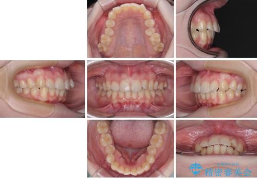 左上の前歯が出ているのが気になる 審美装置による非抜歯ワイヤー矯正の治療前