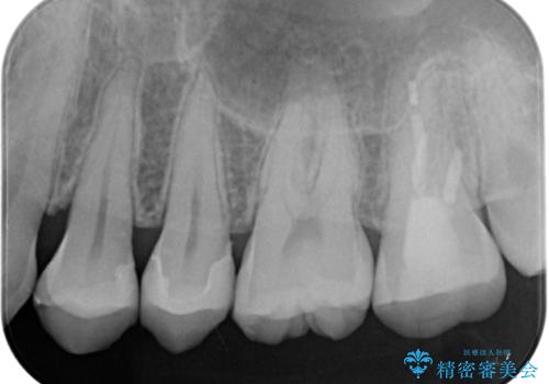 左上がしみて痛い　セラミックインレー修復の治療後