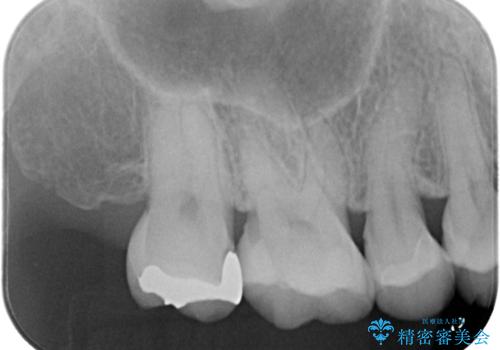 【セラミックインレー】むし歯の再発防止を考えた治療の治療前