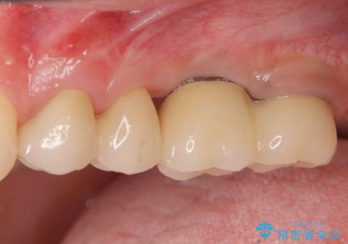 虫歯・破折の放置により重度に吸収した歯槽骨　骨造成後のインプラント治療の治療後