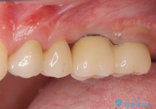虫歯・破折の放置により重度に吸収した歯槽骨 骨造成後のインプラント治療の症例 治療後