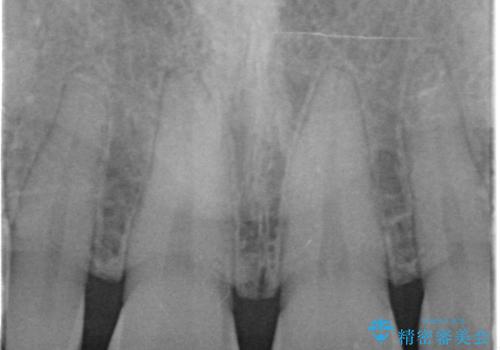 前歯の隙間を埋めたい　矯正かクラウンかの治療前