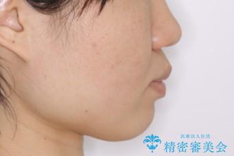 前歯のねじれと深い噛み合わせの改善:インビザライン治療の治療前(顔貌)